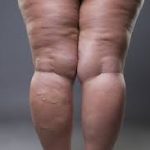 Lipedema: o mês da conscientização sobre a doença que atinge milhões de mulheres brasileiras