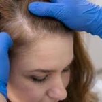 Transplante capilar feminino cresce entre mulheres na menopausa e impulsiona novas técnicas contra rarefação dos fios